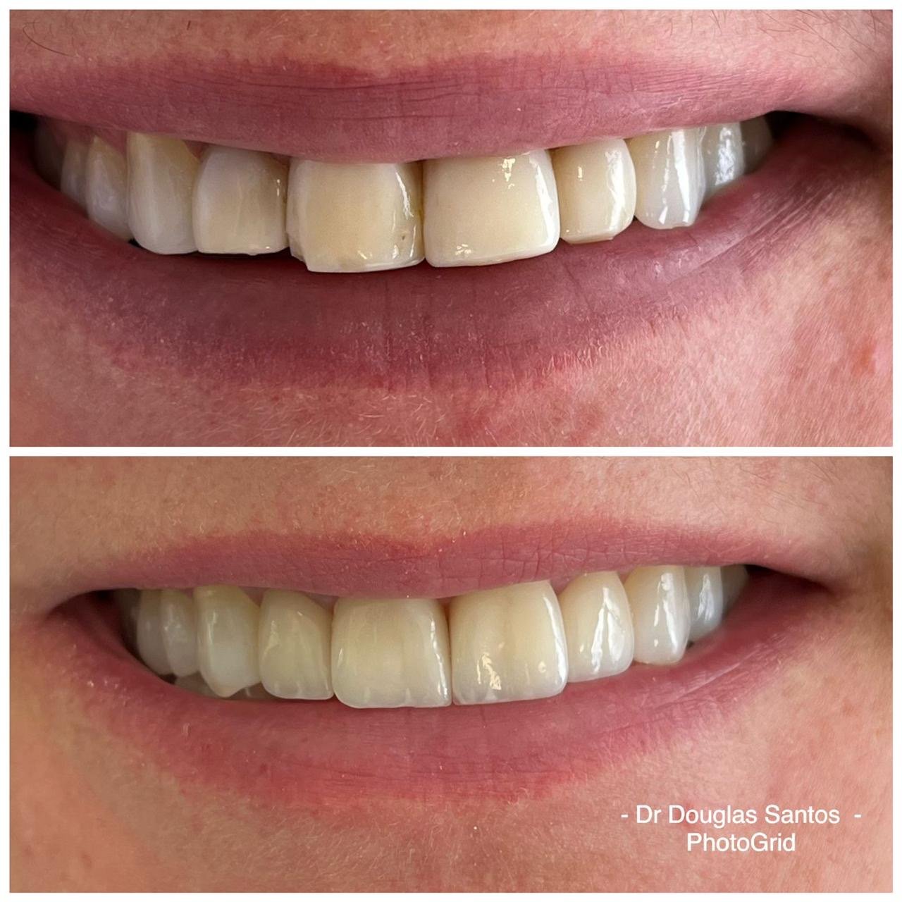Caso clínico odontológico com comparação de sorriso