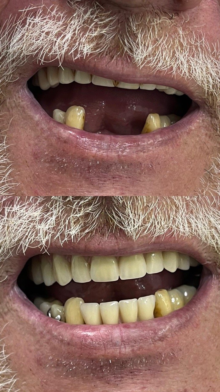 Caso clínico odontológico com recuperação de sorriso