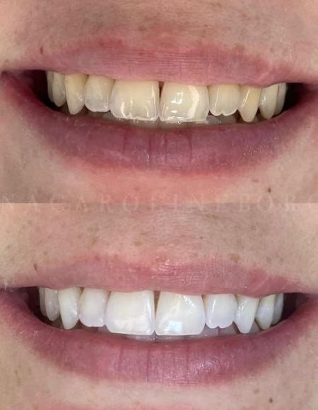 Caso clínico odontológico com clareamento do sorriso
